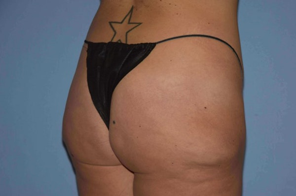 Liposuction Before & After Gallery - Patient 352306 - Image 3