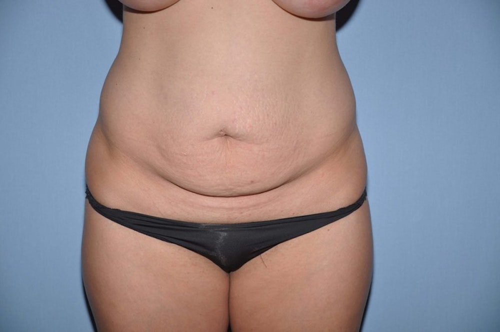 Before and After of Mommy Makeover in Long Island