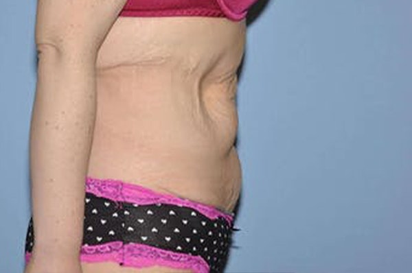 After Weight Loss Surgery Before & After Gallery - Patient 221347 - Image 5