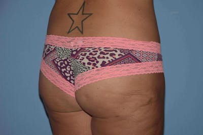 Liposuction Before & After Gallery - Patient 352306 - Image 4