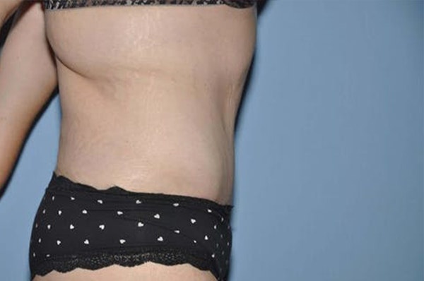 After Weight Loss Surgery Before & After Gallery - Patient 221347 - Image 6