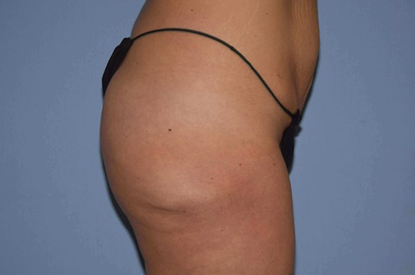 Liposuction Before & After Gallery - Patient 352306 - Image 5