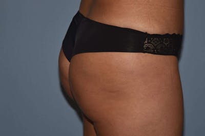 Brazilian Butt Lift Before & After Gallery - Patient 406455 - Image 6
