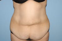 After Weight Loss Surgery Before & After Gallery - Patient 367625 - Image 1