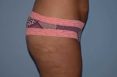 Liposuction Before & After Gallery - Patient 352306 - Image 6