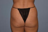 Brazilian Butt Lift Before & After Gallery - Patient 110955 - Image 1