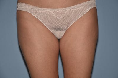 Liposuction Before & After Gallery - Patient 200874 - Image 1