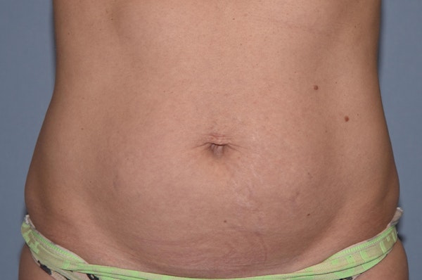 Tummy Tuck Before & After Gallery - Patient 397096 - Image 1
