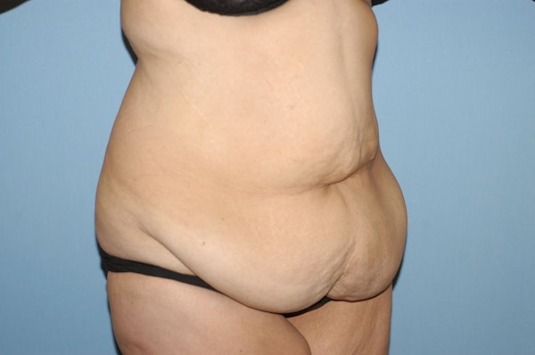 After Weight Loss Surgery Before & After Gallery - Patient 367625 - Image 3