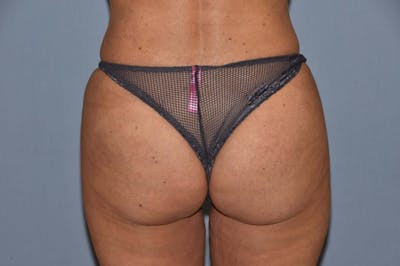Brazilian Butt Lift Before & After Gallery - Patient 110955 - Image 2