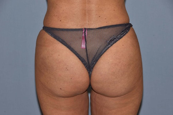Brazilian Butt Lift Before & After Gallery - Patient 110955 - Image 2