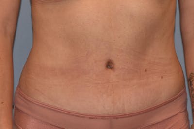 Tummy Tuck Before & After Gallery - Patient 397096 - Image 2
