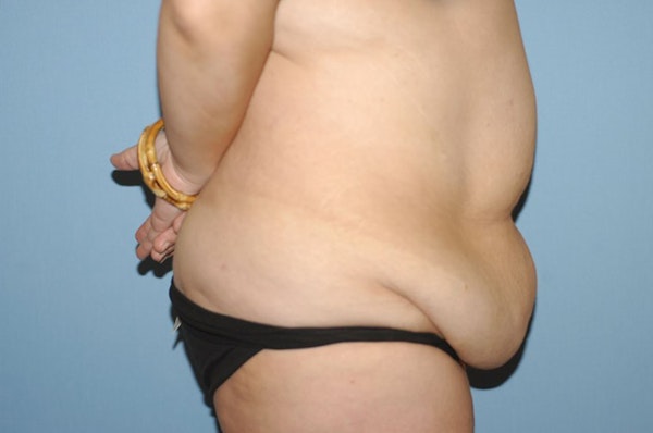 After Weight Loss Surgery Before & After Gallery - Patient 367625 - Image 5