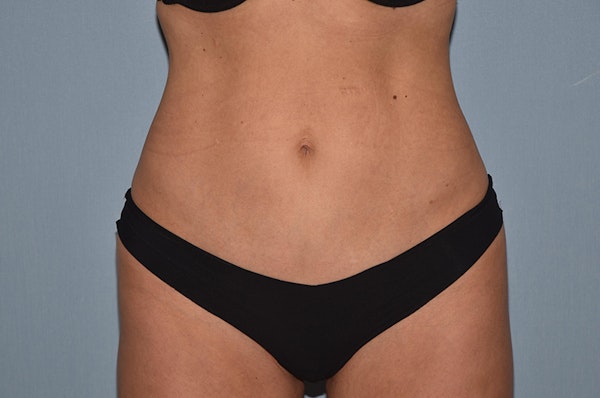 Liposuction Before & After Gallery - Patient 200874 - Image 4
