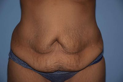 After Weight Loss Surgery Before & After Gallery - Patient 352207 - Image 1