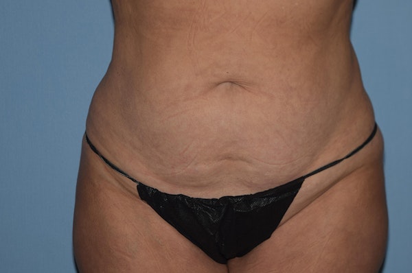 Tummy Tuck Before & After Gallery - Patient 373947 - Image 1