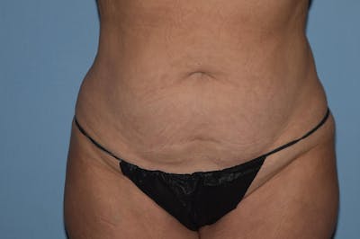 Tummy Tuck Before & After Gallery - Patient 373947 - Image 1