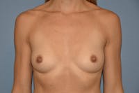 Breast Augmentation Before & After Gallery - Patient 332062 - Image 1