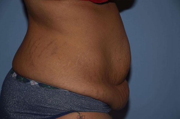 After Weight Loss Surgery Before & After Gallery - Patient 352207 - Image 5