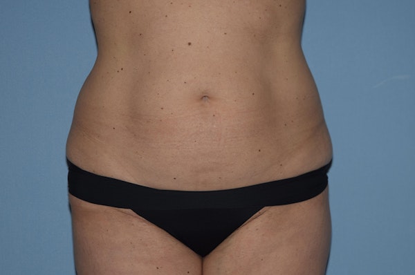 Liposuction Before & After Gallery - Patient 614376 - Image 1