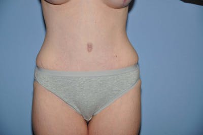 Mommy Makeover Before & After Gallery - Patient 271183 - Image 6