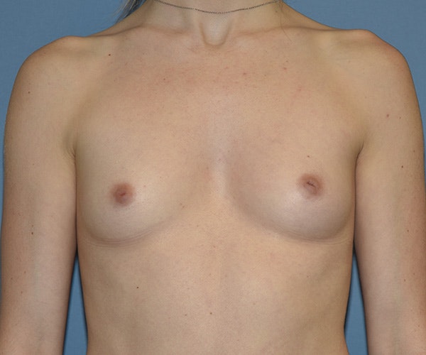 Breast Augmentation Before & After Gallery - Patient 240256 - Image 1