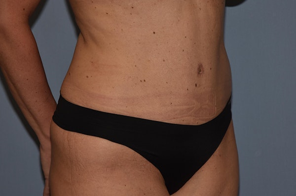 Liposuction Before & After Gallery - Patient 614376 - Image 6