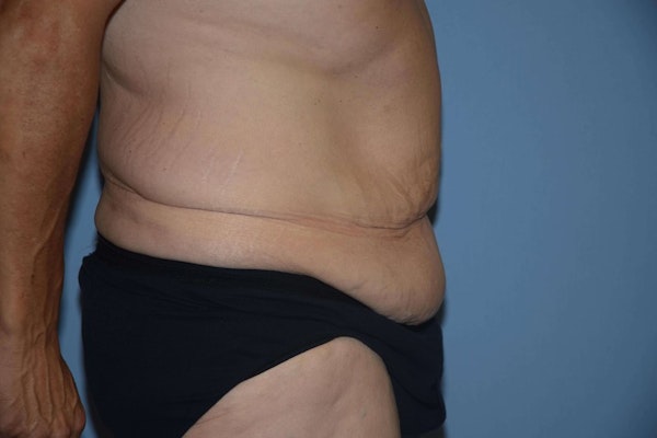 After Weight Loss Surgery Before & After Gallery - Patient 408585 - Image 5