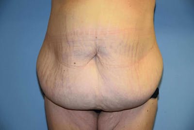 After Weight Loss Surgery Before & After Gallery - Patient 240721 - Image 1