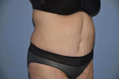 After Weight Loss Surgery Before & After Gallery - Patient 240721 - Image 4