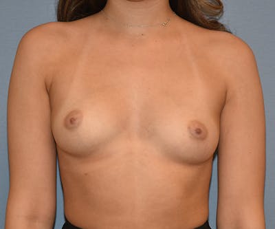 Breast Augmentation Before & After Gallery - Patient 289910 - Image 1