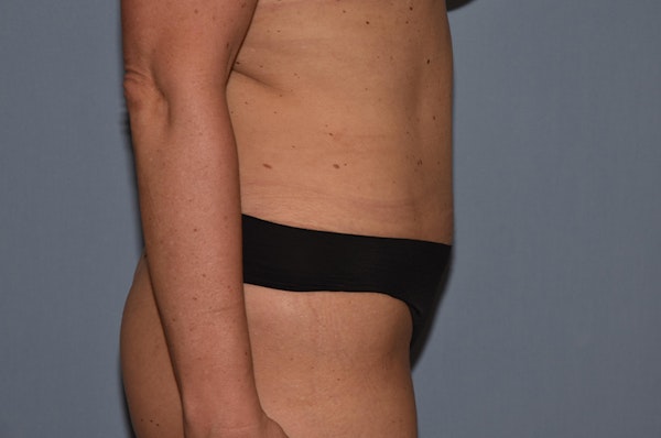 Tummy Tuck Before & After Gallery - Patient 291808 - Image 6