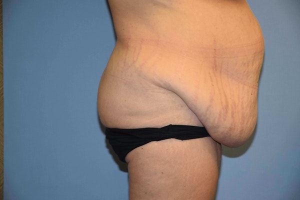 After Weight Loss Surgery Before & After Gallery - Patient 240721 - Image 5