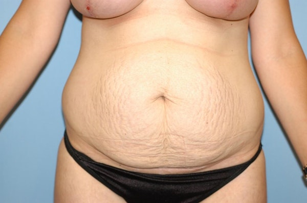 Before and After of Mommy Makeover in Long Island