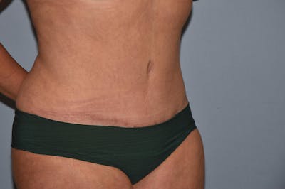 Liposuction Before & After Gallery - Patient 571056 - Image 4