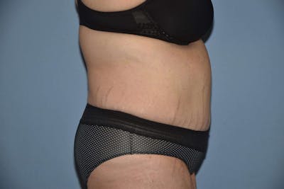 After Weight Loss Surgery Before & After Gallery - Patient 240721 - Image 6