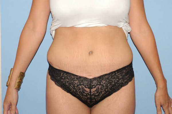 Before and After of Mommy Makeover in Long Island