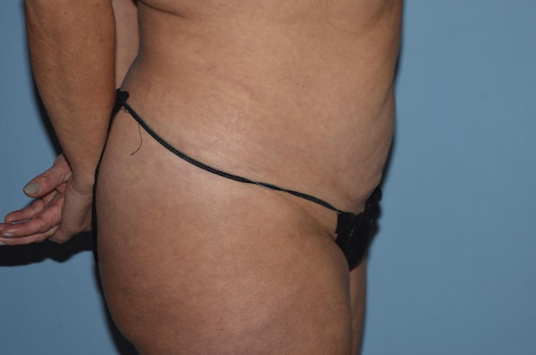 Liposuction Before & After Gallery - Patient 571056 - Image 5