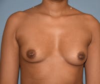 Breast Augmentation Before & After Gallery - Patient 558962 - Image 1