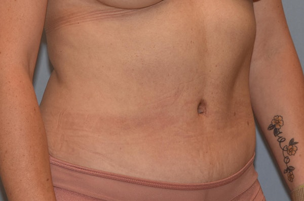 Liposuction Before & After Gallery - Patient 728656 - Image 4