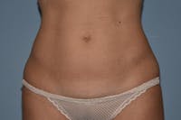 Tummy Tuck Before & After Gallery - Patient 395907 - Image 1
