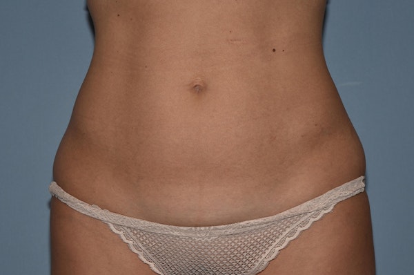 Tummy Tuck Before & After Gallery - Patient 395907 - Image 1