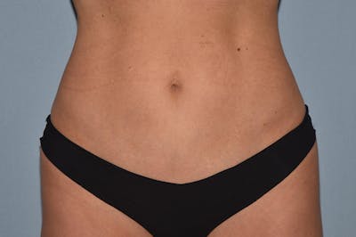 Tummy Tuck Before & After Gallery - Patient 395907 - Image 2