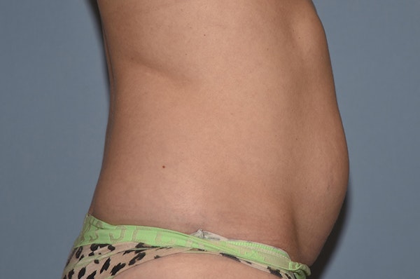 Liposuction Before & After Gallery - Patient 728656 - Image 5