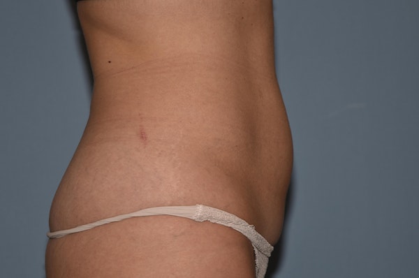 Tummy Tuck Before & After Gallery - Patient 395907 - Image 3