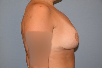 Breast Reduction Before & After Gallery - Patient 240522 - Image 6