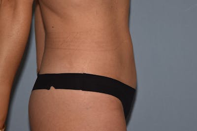 Tummy Tuck Before & After Gallery - Patient 395907 - Image 4