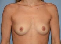 Breast Augmentation Before & After Gallery - Patient 209138 - Image 1