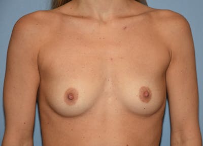 Breast Augmentation Before & After Gallery - Patient 209138 - Image 1