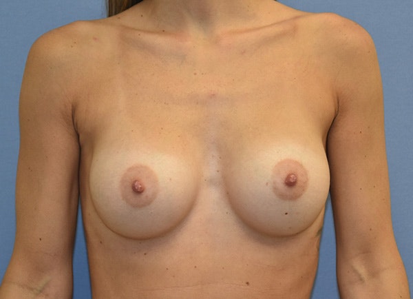 Breast Augmentation Before & After Gallery - Patient 209138 - Image 2